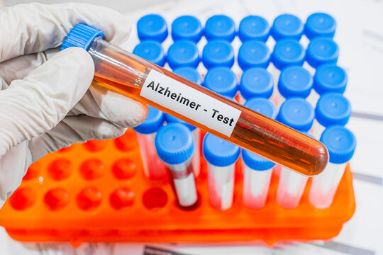 blood sample in lab test tube for Alzheimer test