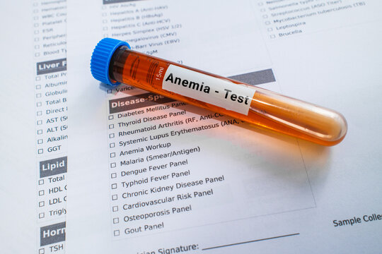 blood sample in lab test tube for Anemia test