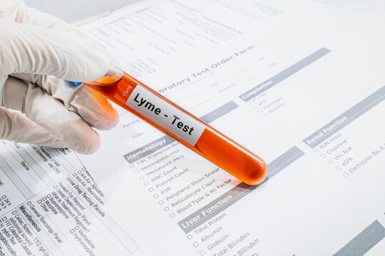 blood sample in lab test tube for Lyme test