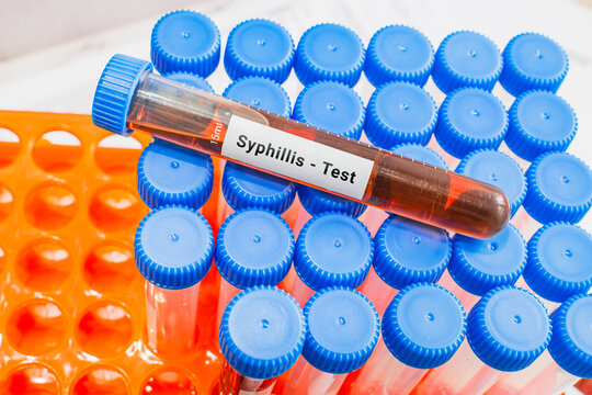 blood sample in lab test tube for Syphillis