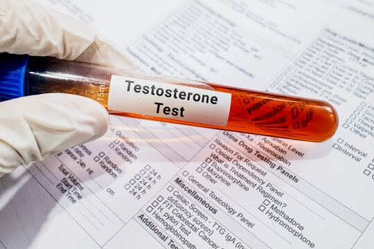 blood sample in lab test tube for Testosterone