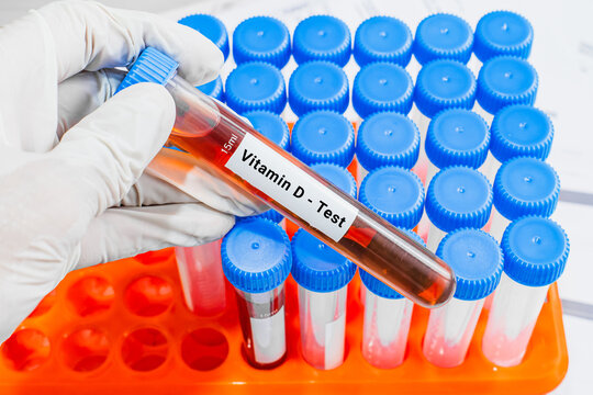 blood sample in lab test tube for vitamin D