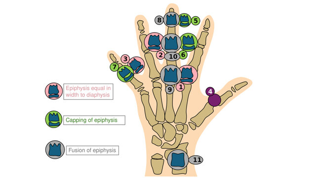 Skeletal maturity indicators of hand and wrist bone age assessment vector