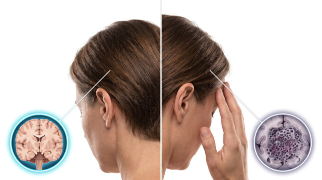 Brain tumor symptoms and headache pain, medical illustration comparing healthy brain tissue with abnormal brain tumor scan