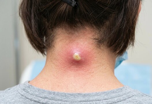 Large Painful Abscess On Woman Neck. Closeup view