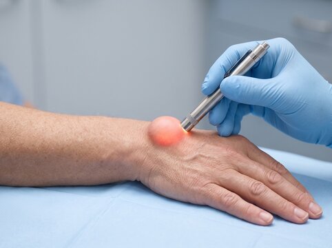 Transillumination Test for a Cystic Fluid-Filled Swelling