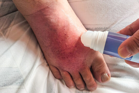 Hand applying anti-inflammatory gel onto swollen inflamed painful right foot due to acute gout attack