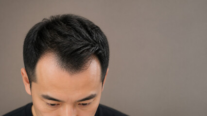 Fototapeta premium Top View of M-Shaped Receding Hairline