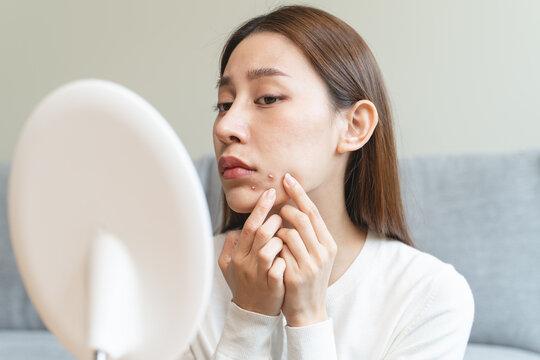 Asian young woman worry about acne on her face after wear face mask.