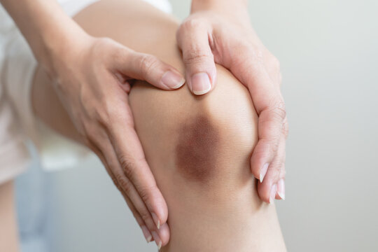Close up of a painful dark bruise and hematoma on the knee of an Asian woman after an accidental fall or physical injury