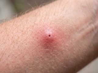 Naklejka premium Close up of red swollen skin after an insect bite or localized allergic reaction