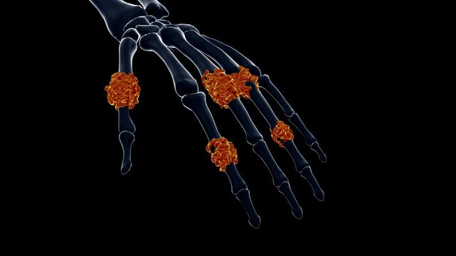 Medical dynamic video materials on bone and joint diseases