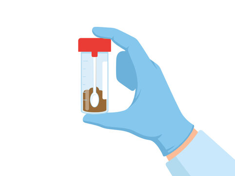 Gloved hand holding a stool sample container for medical laboratory analysis