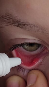 Applying eye drops to soothe redness and irritation in a person's eye in clear, focused steps