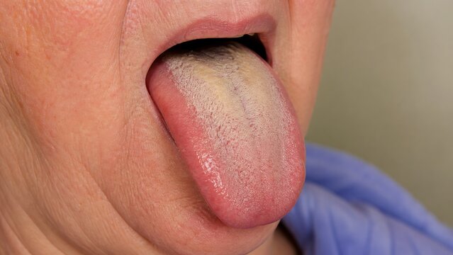 Moderate Tongue Coating with Visible Papillae