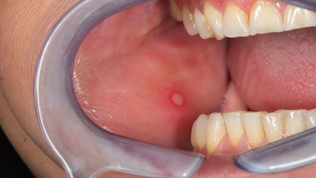 Single Aphthous Ulcer on Oral Mucosa