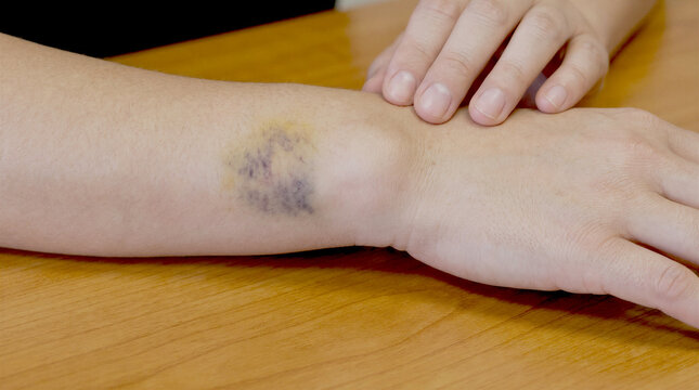 Close-up of a bruise or hematoma on a person wrist on a wooden table