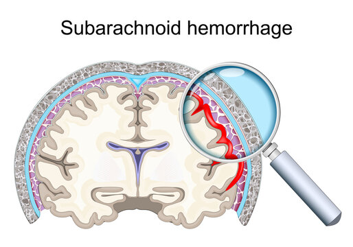 Subarachnoid hemorrhage. Intracranial bleeding around the brain