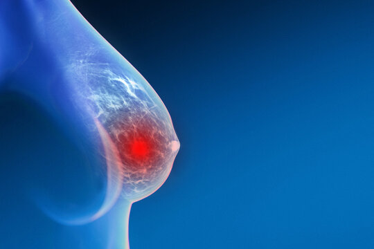 translucent female breast, styled as a mammogram, showing complex internal structure with a prominent, glowing red sphere representing a tumor or cancer nodule on a gradient blue background