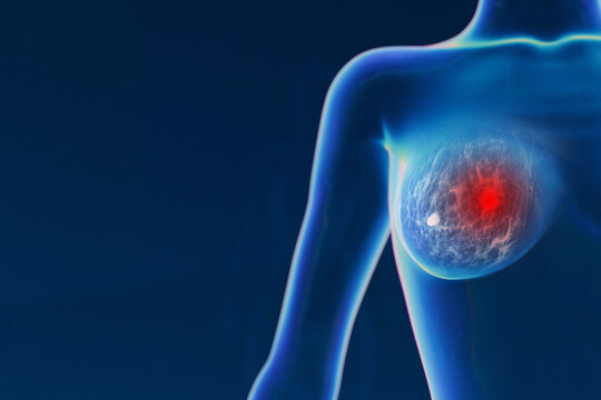 translucent female torso showing a detailed internal structure of one breast with a prominent, highlighted glowing red tumor nodule on a dark blue background with copy space. Cancer breast, concept