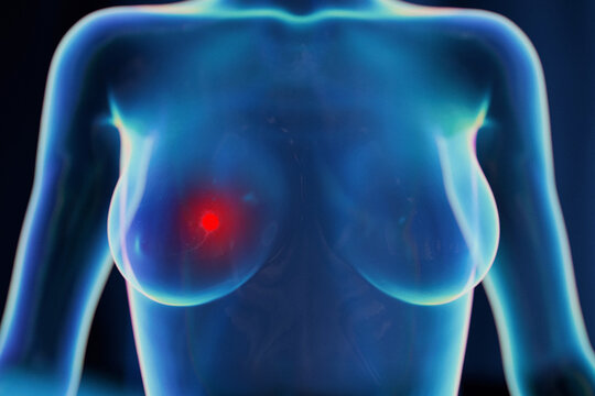 3D medical illustration of a transparent female torso displaying a glowing red tumor in the breast area, representing breast cancer diagnosis, mammography scan, and oncology research.