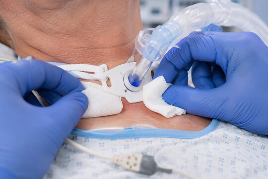 Close-up shot of an ICU nurse's hands wearing blue nitrile gloves carefully inserting a split gauze dressing pad under a tracheostomy tube flange, bright hospital room