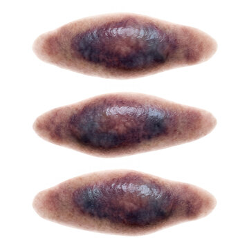 Tr&ecirc;s pr&oacute;teses realistas de silicone simulando hematomas ou feridas de pele para maquiagem de efeitos especiais, isoladas em fundo branco.