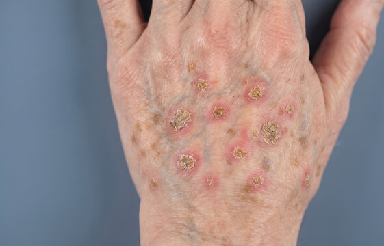 Close Up of Senior Hand with Actinic Keratosis Precancerous Skin Lesions and Sun Damage