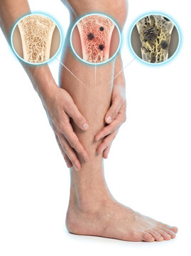 Leg Skin Aging Skin Damage Tissue Degeneration, medical illustration showing progressive skin deterioration and structural changes in the lower leg