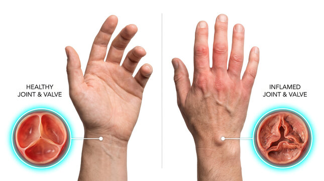 Arthritis Hand Joint Inflammation, medical illustration comparing healthy and inflamed finger joints with pain swelling and tissue damage