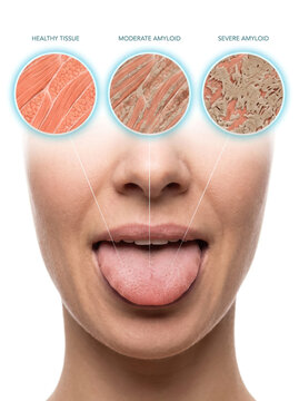 Tongue Atrophy Tongue Aging Oral Health, medical illustration showing healthy tongue and progressive muscle atrophy with surface tissue changes