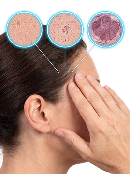 Scalp Aging Hair Follicle Skin Damage, medical illustration showing progressive scalp and hair follicle changes with tissue deterioration