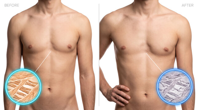 Muscle Atrophy Muscle Loss Muscle Weakness, medical illustration comparing healthy chest muscle tissue with progressive muscle degeneration