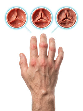 Rheumatoid Arthritis Hand Joint Inflammation, medical illustration showing progressive joint damage swelling and deformity affecting the fingers