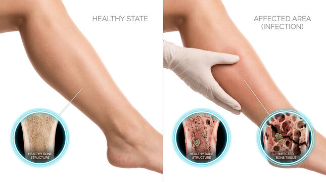 Skin infection comparison healthy and affected leg, lower limb inflammation and tissue infection concept for dermatology medical education