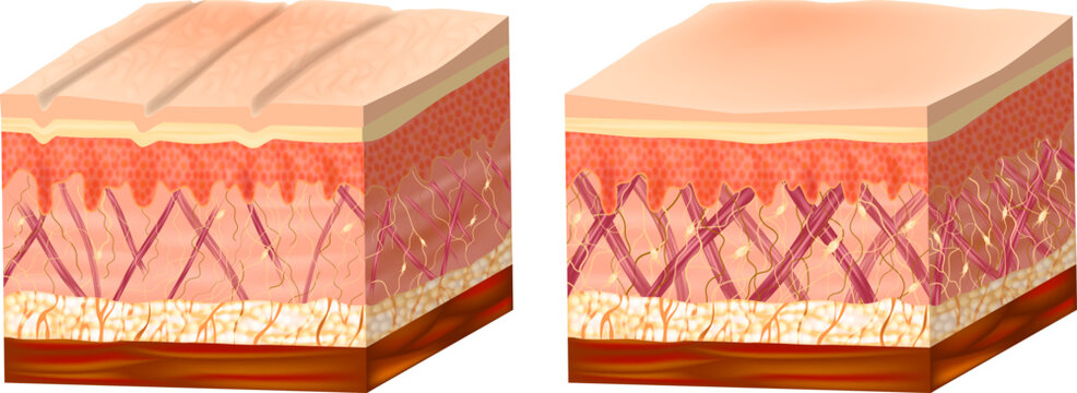 Medical illustration comparing young and aged human skin structure. Cross section shows collagen and elastin fibers, fibroblasts, dermis, epidermis, wrinkles and age-related changes.