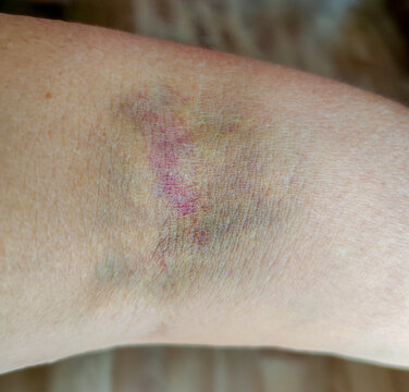 Close-up of a colorful healing bruise in the inner elbow area after a blood draw or injection, showing red, purple, blue-gray, green, and yellow discoloration characteristic of a resolving hematoma.