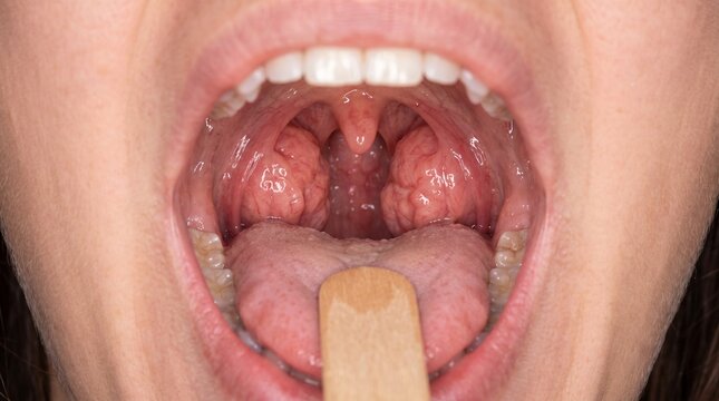 Enlarged Palatine Tonsils in a Clinical Oral Examination &mdash; Healthcare Background