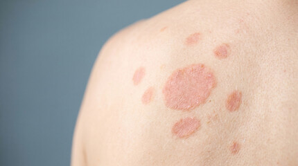Naklejka premium Pityriasis rosea Skin Condition Concept Showing Oval Salmon-Toned Patches in a Clinical Stock Composition