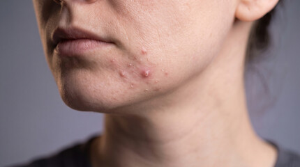 Naklejka premium Acne Skin Condition Concept Showing Small Inflamed Blemishes in a Clinical Stock Composition