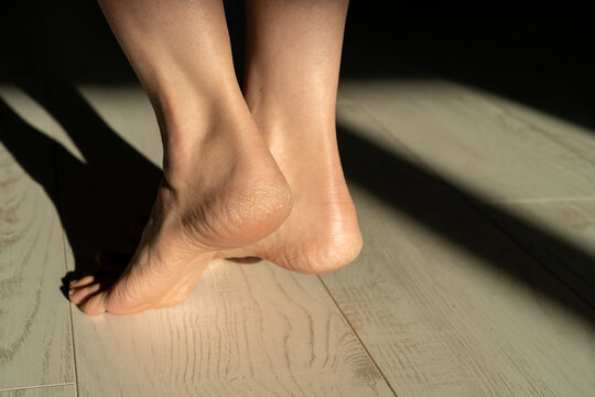 Close-up of a Diabetic woman's feet on a wooden floor with a dry cracked heel