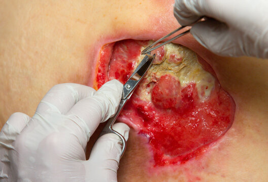 Surgeon performing surgical debridement and cleaning of a deep pressure ulcer on a patient's lower back using medical instruments. Wound care and treatment.