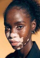Obraz premium Portrait of Woman with Vitiligo Against Warm Ochre Background
