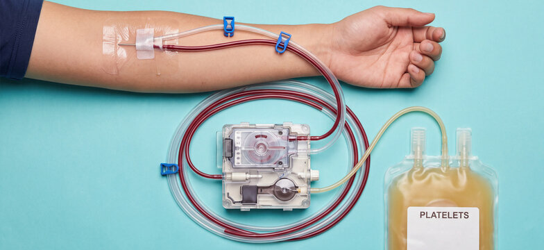Platelet donation procedure using blood apheresis machine and tubing connected to donor arm