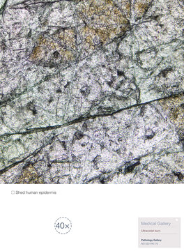 This is the shed epidermis of human skin, resulting from ultraviolet burns sustained on the upper arm while traveling in a high-altitude region.Magnify 40x.
