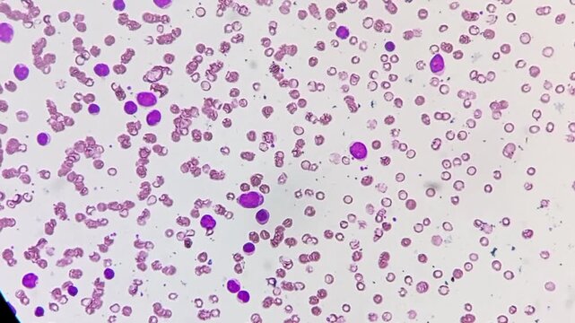 Acute myeloid leukaemia (AML). Left shift with atypical looking with large mononuclear cells with 1-2 nucleoli, scanty cytoplasm.