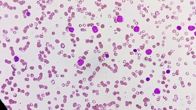 Acute myeloid leukaemia (AML). Left shift with atypical looking with large mononuclear cells with 1-2 nucleoli, scanty cytoplasm.