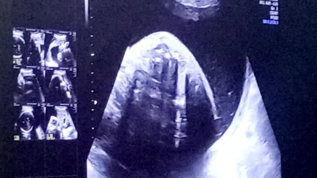 An anomaly scan is a detailed mid-pregnancy ultrasound performed between 18 and 22 weeks to check your baby's physical development, organ structure, and growth.