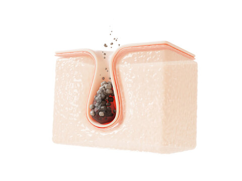 3d skin cross-section with clogged pore, dark acne particles and bacteria for medical dermatology treatment. Blackhead removal, deep cleansing, beauty cosmetic skin care product