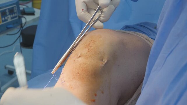 Surgeon Closing Arthroscopy Incisions with Surgical Sutures on Patient Knee